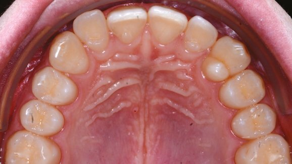 Risoluzione dell’affollamento mediante F22 Aligner