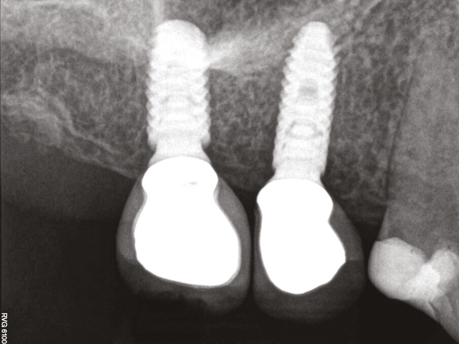 Fig.21: 1 year post x-ray showing bone formation over the top of the Axiom REG implants. 