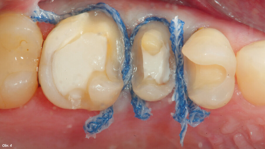Konvenční retrakce měkkých tkání vláknem před pořízením digitálního otisku.