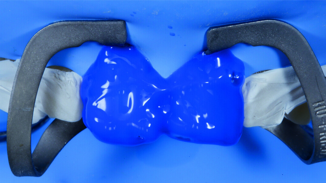 Fig. 14: Orthophosphoric acid etching of a substrate that was still enamel thanks to the extremely minimally invasive approach adopted.