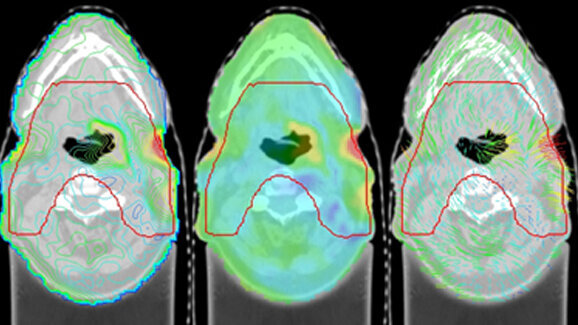 Punktgenaue Strahlentherapie für Krebspatienten
