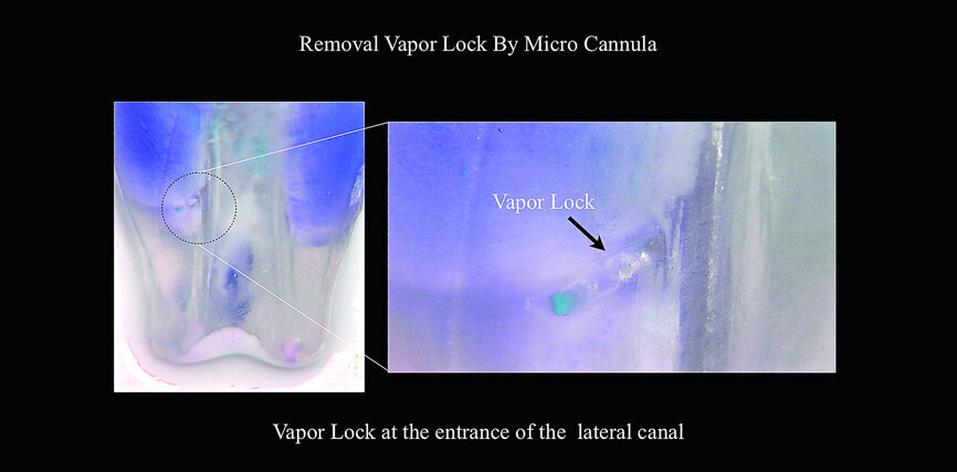 Fig. 1a: Sleiman-Iandolo testing. Showing a gas bubble locked inside a lateral canal as a result of passive ultrasonic irrigation (PUI).