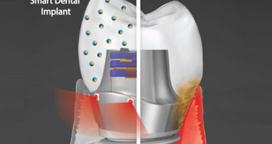 Researchers developing  antibacterial smart dental implant that uses phototherapy