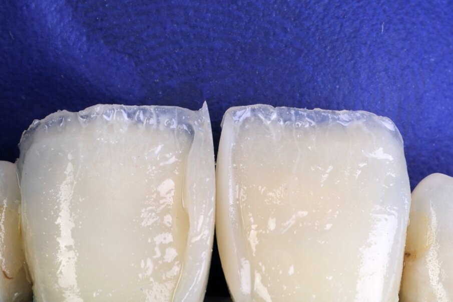 Fig. 10: Build-up of dentin layer with Beautifil II LS shade A2. 