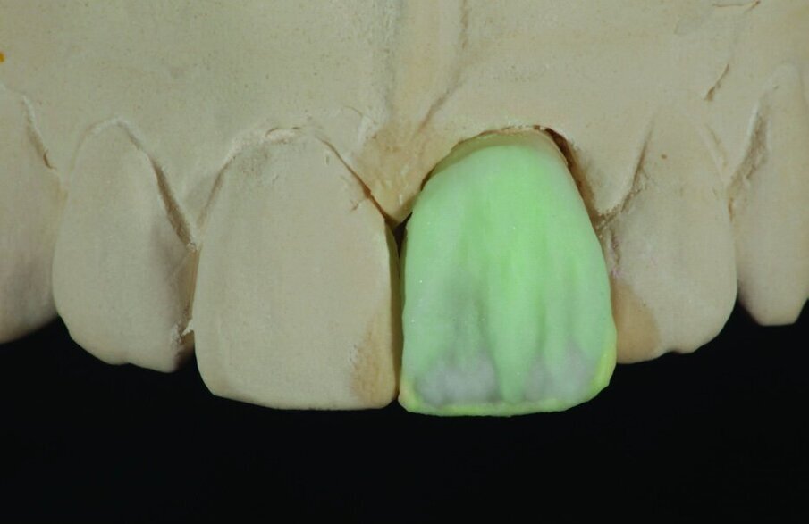 Figs 4, 5, 6 and 7: The versatile range of IPS e.max Ceram materials allows you to imitate bleached tooth shades showing lifelike light reflection.