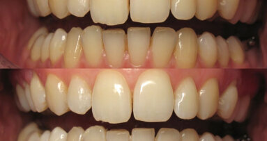 Ortodoncia y Blanqueamiento: La guinda del pastel