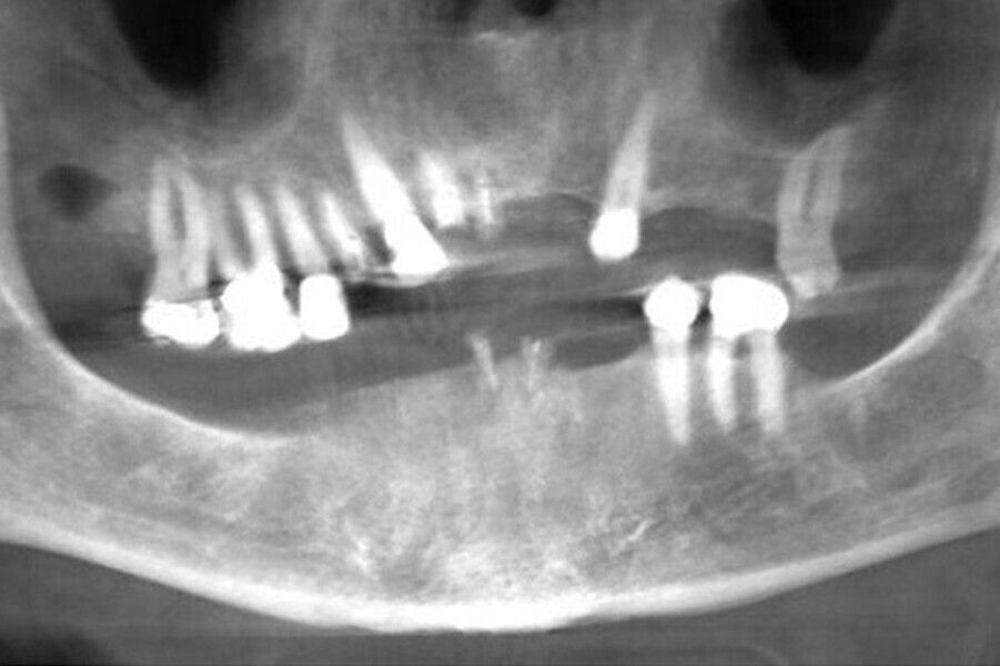 Fig. 21. Rx Pre-operatoria, Prótesis híbrida inmediata con 5 años de evolución y Rx Control a los 5 años.