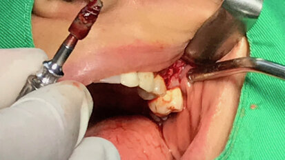 Explantace a okamžitá implantace kombinací reverzního krouticího momentu a trepanační frézy