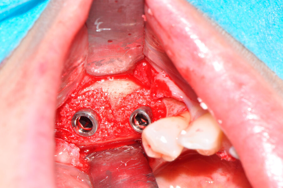 Fig. 6 - I due difetti perimplantari sono innestati col biomateriale a lento riassorbimento.