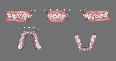Invisalign Personalized Plan: una nuova funzionalità time-saver per medico e paziente