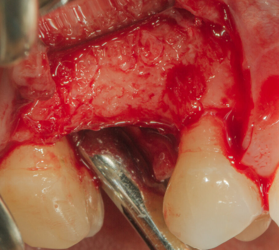 Fig. 19 - Visione vestibolare.