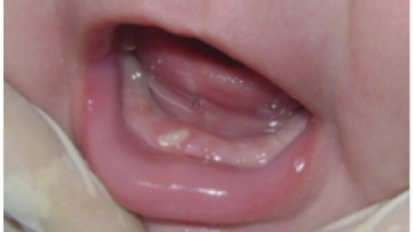 Tratamiento de úlcera de Riga-Fede en un bebé con antecedente de reacción adversa por uso de benzocaína