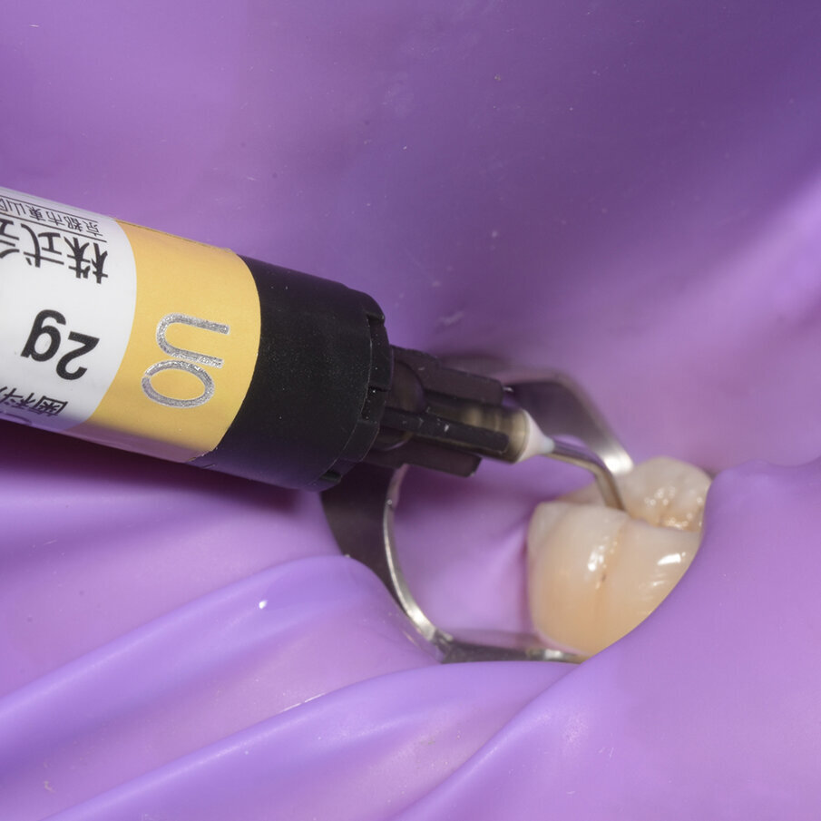 Fig 5: Beautifil Opaquer Shade UO applied to mask the amalgam “tattoo” at the base of the cavity  