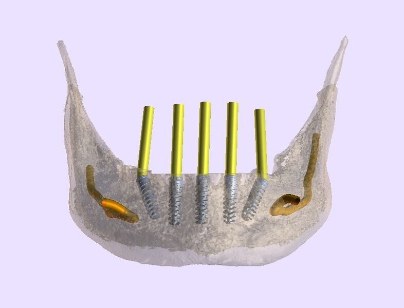 Fig. 8b: Transparent STL model and virtual teeth.