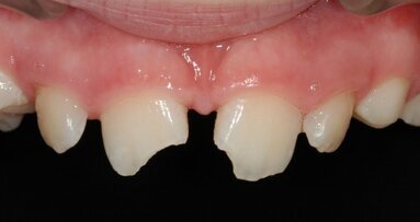 Epidemiologia e approcci innovativi nei traumi dentali (una branca piuttosto trascurata dell’odontoiatria)