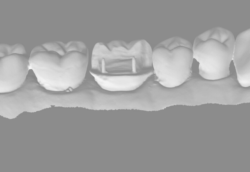 Fig. 14b: Scanned pinlay preparation on tooth #36 exported as an STL file.