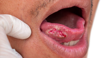 Study identifies gaps in Turkish dentists’ knowledge of oral cancer and mucosal lesions