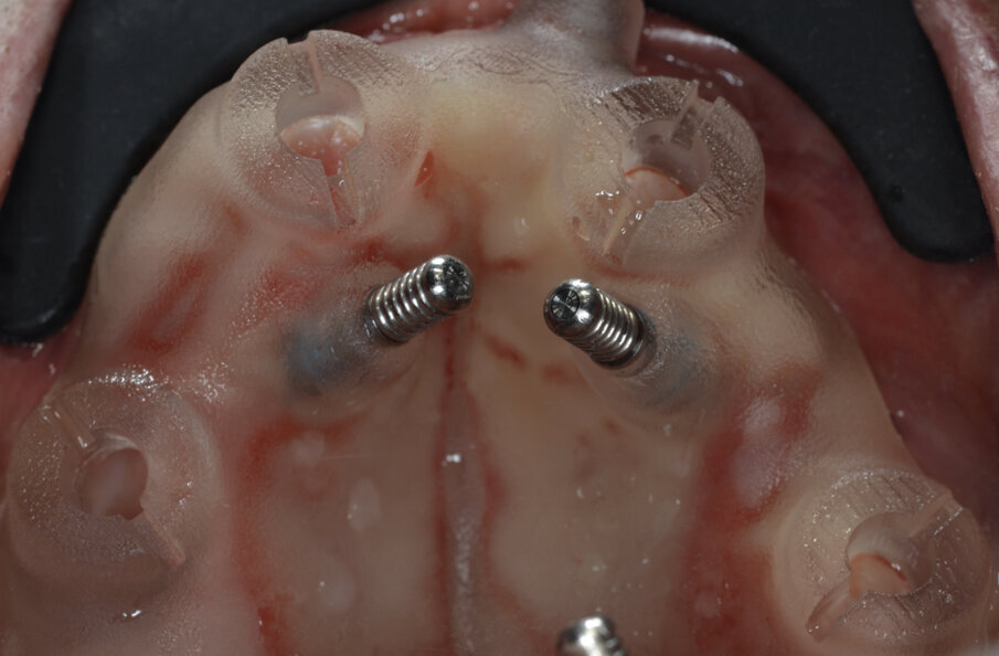 Fig. 12_Template chirurgico realizzato da New Ancorvis fissato con pin.