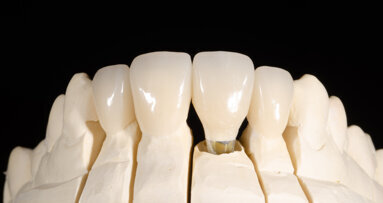 Anterior crowns on teeth and an implant