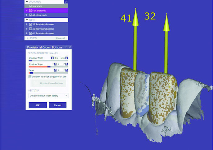 Fig. 9a: Positioning of the insertion angle of the future preparation (a). Adjustment of the thickness of the walls of the temporary bridge (b).