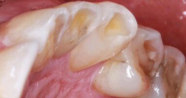 Innovaciones en el manejo del bruxismo y de la ATM (1)