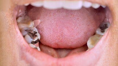 WHO advances action on dental amalgam phase‑out across Southeast Asia