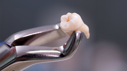 Studie belegt: Diabetes verursacht Zahnverlust Studie belegt: Diabetes verursacht Zahnverlust