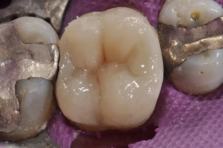 Fig. 10: Acabado de la restauración.