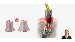 Keystone Dental Group – Genesis Active – Innovative Multi-Unit Abutment Solutions