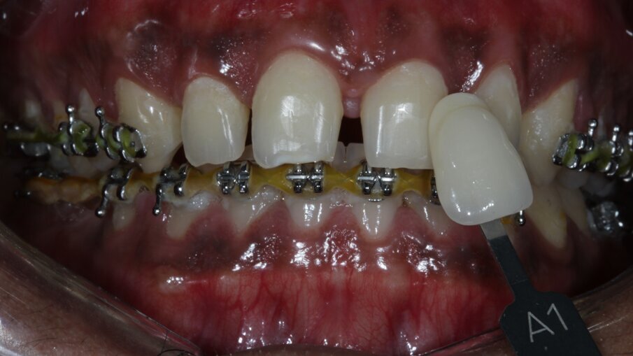 Fig 11: Shade selection