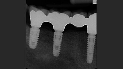Open-cohort prospective study on early implant failure and physiological marginal remodeling expected using sandblasted and acid-etched bone level implants featuring an 11° Morse taper connection within one year after loading