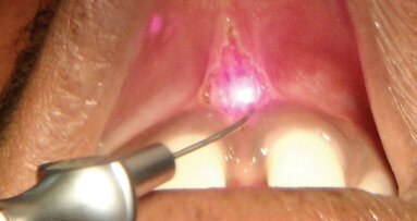 Frenektomie – Srovnání konvenčních technik a diodového laseru