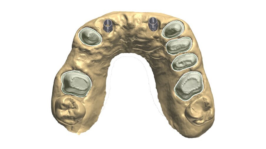 Fig. 31_L’impronta definitiva consente di rilevare in una sola seduta gli entrambe le arcate, gli elementi naturali, la posizione degli impianti, i provvisori in posizione centrica.