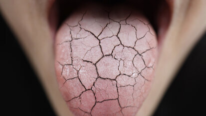 “We are thinking beyond dentistry”: Study helps clinicians identify Sjögren’s syndrome