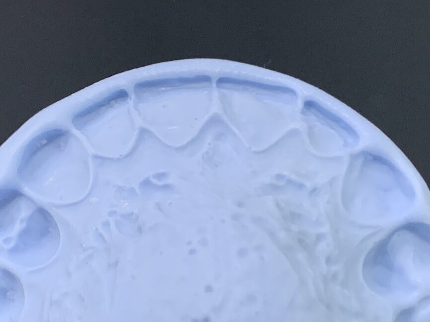 Fig 9 : index with incisal wrap to help duplicating the thickness of the incisal edge