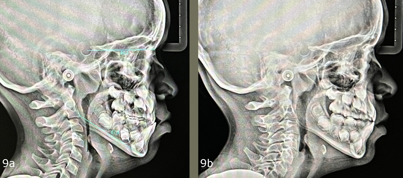 Figs. 9a & b: Lateral cephalograms before (a) and after therapy (b).