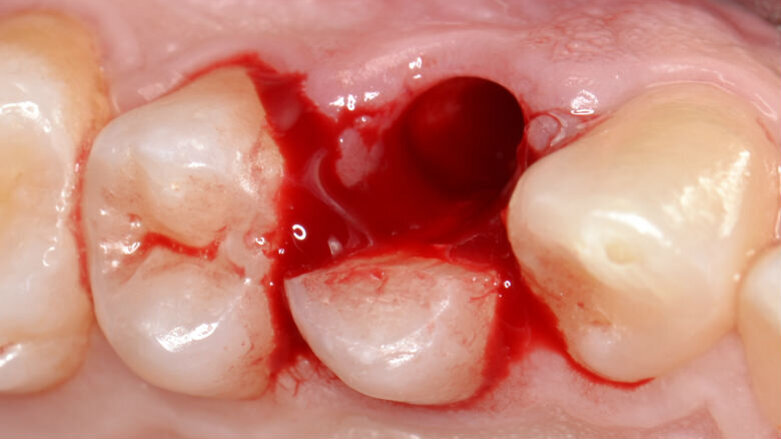 Riabilitazione di un sito monoedentulo con impianto postestrattivo a provvisorizzazione immediata