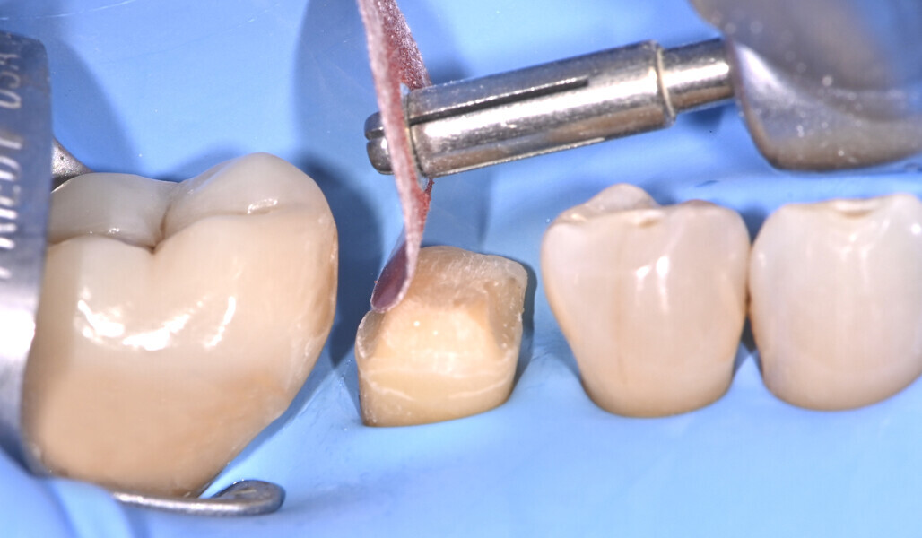 Fig. 8: Rounding off of the sharp edges. 