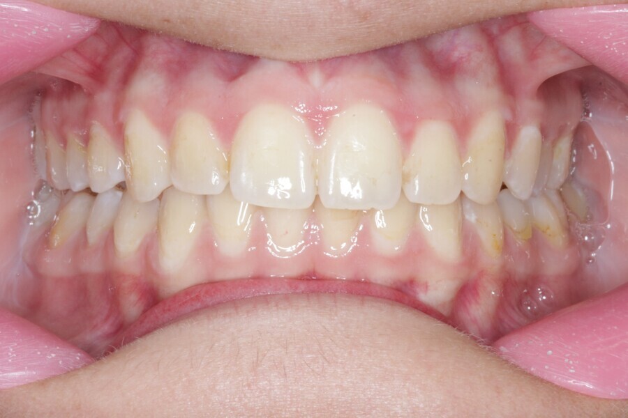 Fig. 23: Final situation after 25 Reveal aligners.