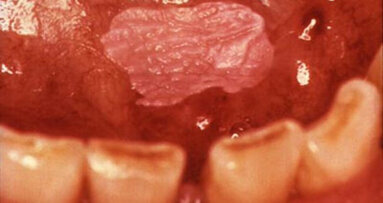 Mondonderzoek spoort orale kanker niet tijdig op