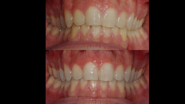 Valutazione clinica dello sbiancamento combinato post Invisalign: case report