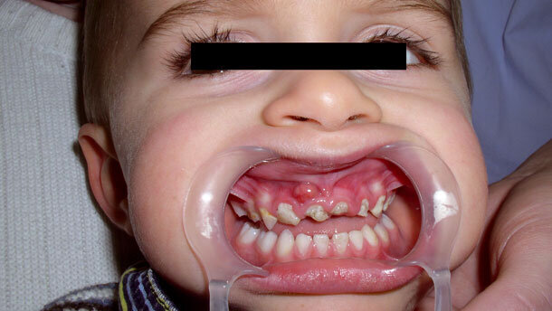 Narkose-Sparkurs: Kinderzahnärzte und Anästhesisten schlagen Alarm