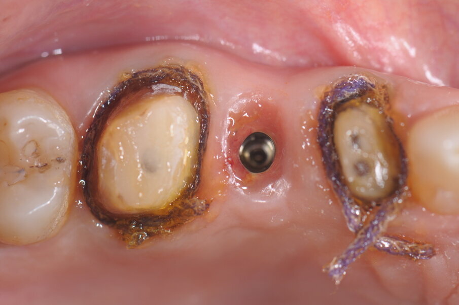 Fig. 6 - Posizionamento dei fili retrattori secondo la tecnica del doppio filo, appena prima dell’impronta si procede alla rimozione del II° filo e della vite di guarigione implantare.