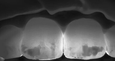 Quando la mini invasività migliora l’estetica: il trattamento di una MIH, dalla microabrasione all’infiltrazione, passando attraverso la remineralizzazione