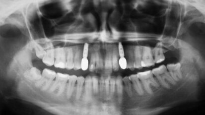 Użycie matrycy kolagenowej mucoderm® do pokrycia recesji tkanek miękkich i poszerzenia strefy dziąsła nieruchomego – opis przypadku