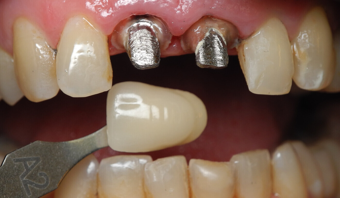 Fig. 3: Shade determination using a shade tab. A2 was the appropriate shade.