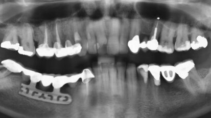 Implanty żyletkowe – relikt przeszłości czy pełnoprawna metoda terapii?