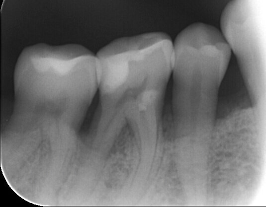 Fig. 15 - Rx peri-apicale dell’elemento 4.6.: re-mineralizzazione dei tessuti duri.