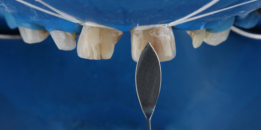 Fig 2: Contouring the buccal surface