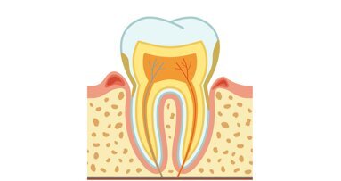 Parodontitis verhoogt risico op beroerte bij mensen onder de 50